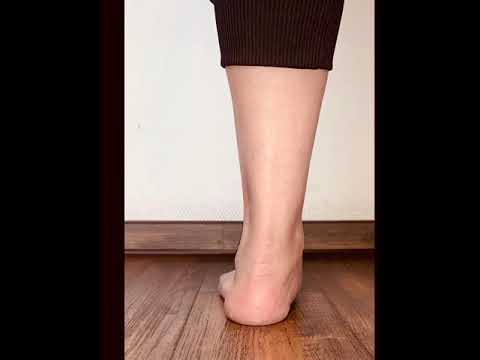 Video: Bagaimana cara didiagnosis kaki rata?