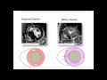 Why CMR Webinar 9: CMR in hypertrophic cardiac conditions Part II