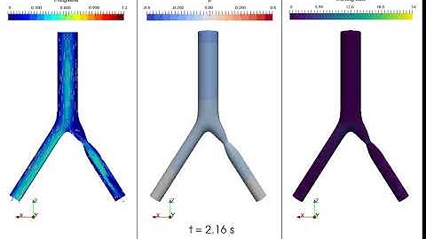 CFD Simulation of Idealised Iliac Bifurcation with Stenosis and Constant Outlet Pressure