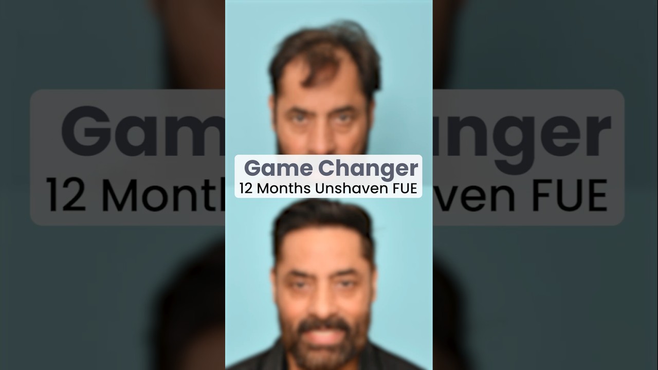 Unshaven FUE Hair Transplant in Delhi | 3200 Grafts | Best Hair Transplant Cost in Delhi NCR