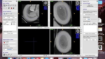 sample itk SNAP semi-automatic segmentation