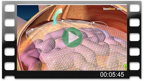 DynaMesh®-IPOM - Animation: Laparoscopic Repair of Incisional Hernia