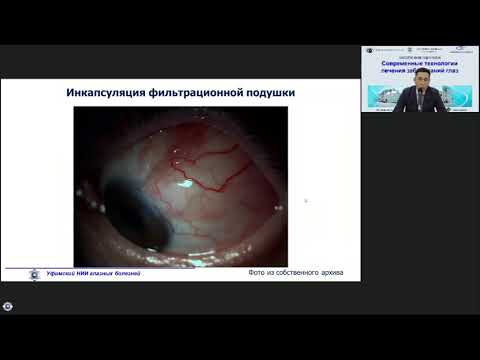 Video: Lieči trabekulektómia glaukóm?