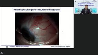 видео: Хуснитдинов И.И. (Уфа )Трабекулэктомия: техника, ведение, осложнения картинка: Хуснитдинов И.И. (Уфа )Трабекулэктомия: техника, ведение, осложнения