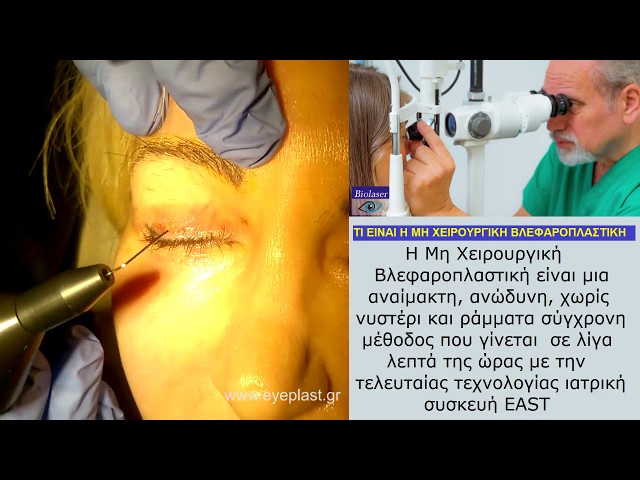 Βλεφαροπλαστική Μη Χειρουργική - Βασίλης Παπαδόπουλος, Οφθαλμίατρος
