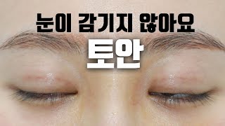 당신의 눈이 안 감기는 이유 그리고 그 해결법(눈매교정/재수술)