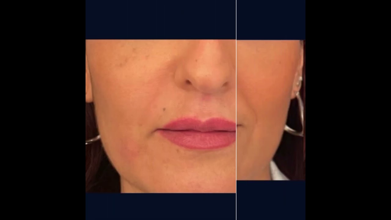 Avant après injection sillon nasogénien 