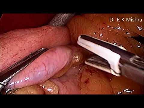 laparoscopic-sleeve-gastrectomy-surgery-video-explained-step-by-step