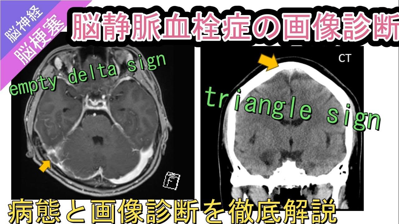 脳静脈血栓症の画像診断