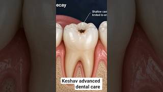 Small Decay # Save # Escape from RCT# composite filling