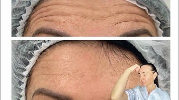 You don’t need Botox anymore | FOREHEAD WRINKLES AND FROWN LINES