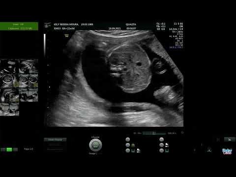 Ecografia com 22 semanas e ainda não sabíamos o sexo do bebê!!