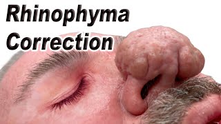 Rhinophyma Surgical Correction by Fauquier ENT 14,261 views 4 months ago 4 minutes, 13 seconds