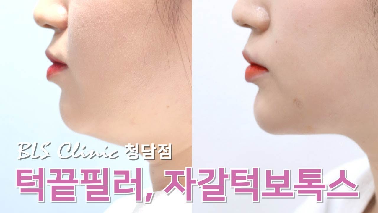 턱끝필러 자갈턱보톡스 시술 영상 BLS클리닉 청담점 선정릉역 피부과, 보톡스, 필러 - YouTube