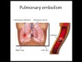 Pulmonary Embolism