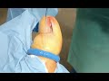 Técnica de Fenol para el tratamiento de la onicocriptosis. Cirugía de la uña
