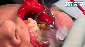 Smilefast: Bite Turbos