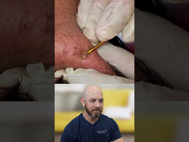 Extracting Large Blackheads: A Close-Up