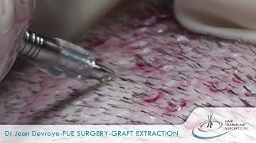 FUE-HAIR TRANSPLANT-Dr DEVROYE-Belgium-Europe.