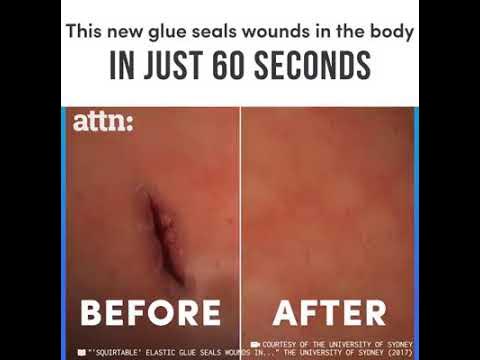 ATTN: - This glue seals wounds in the body in just 60 seconds.