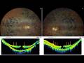 LHEP in Retinitis Pigmentosa: Negative Stain, ICG Peel & Macular Hole Closure