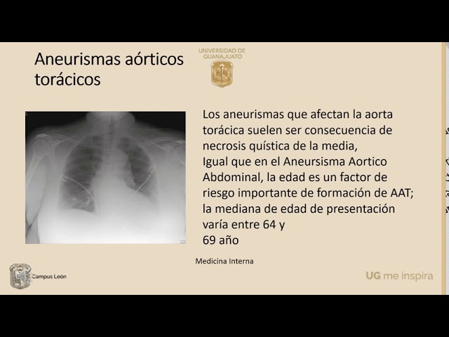 Radiografia De Aneurisma De Aorta Abdominal Aneurisma Micótico De La
