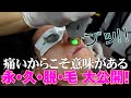 【密着】アナウンサーのヒゲ脱毛風景をお見せします。
