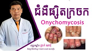 ជំងឺផ្សិតក្រចក-Onychomycosis