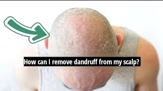 How can I remove dandruff from my scalp