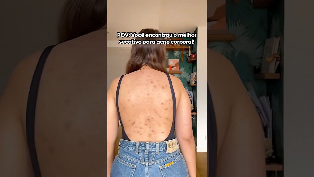 Você sofre com manchas nas costas? 