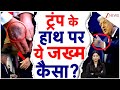 Trump Health Mystery:क्या बिगड़ रही है सुपरपावर देश के राष्ट्रपति की हालत, ट्रंप के निशान ने चौंकाया