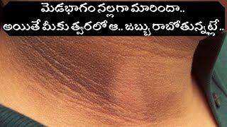 Acanthosis Nigricans Causes and Treatment – Health Tips in Telugu - Healthy Life