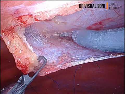 Robotic Ventral TAPP Meshplasty