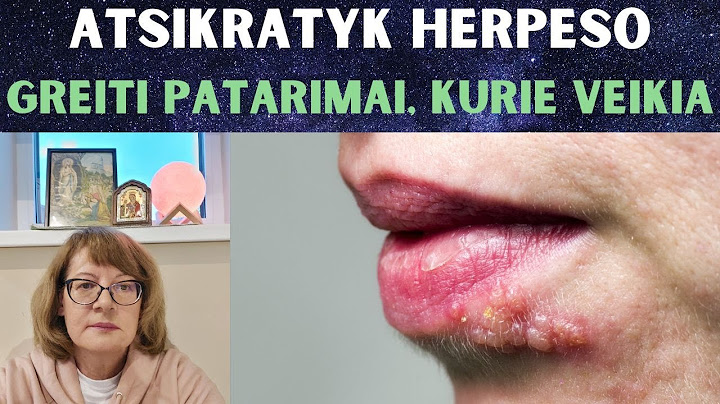 Atsikratyk Herpeso: Greiti Patarimai, Kurie Veikia