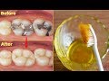 एक बार में दांत का कीड़ा और दर्द बाहर निकालने का बेहतरीन उपाय - How To Get Rid Of Tooth Cavity