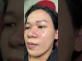 남자 점 제거 후기｜피부 인상이 깔끔해지는 순간