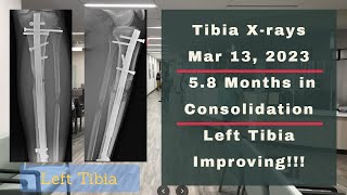 Height Journey - Tibia X-rays 5.8 Months In Consolidation - March 13, 2023