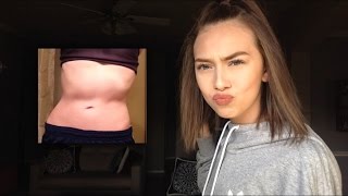 Scoliosis Q&A #2