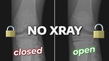 How To CHECK If Your Growth Plates Are Still OPEN! (Without X-ray)