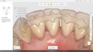 Designing a 3D-printable orthodontic retainer using the Medit Design app screenshot 4