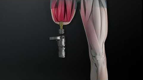 OPL osseointegration for above knee amputees