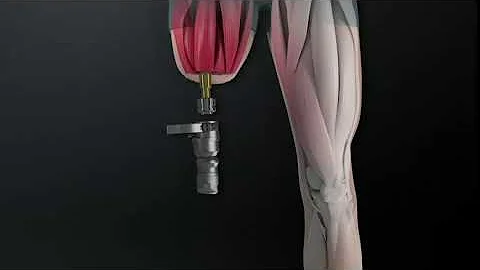 OPL osseointegration for above knee amputees