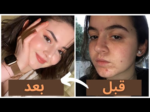 آساسيات العناية بالبشرة كيف تخلصت من حب الشباب