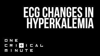 ECG Changes in Hyperkalemia - One Critical Minute [1CM]