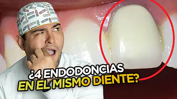 ¿Cuántas endodoncias puede hacer un dentista a la vez?