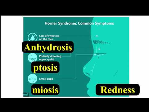 Video: Horners Syndrom: Orsaker, Symtom Och Behandlingar