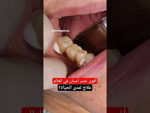 جسر الاسنان زيركونيا الثابت