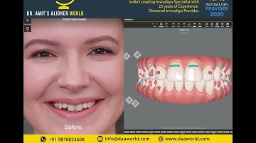 Before / After Invisalign results by Dr Amit sachdeva