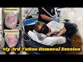 My Third Tattoo Removal Session: Potentially my last!