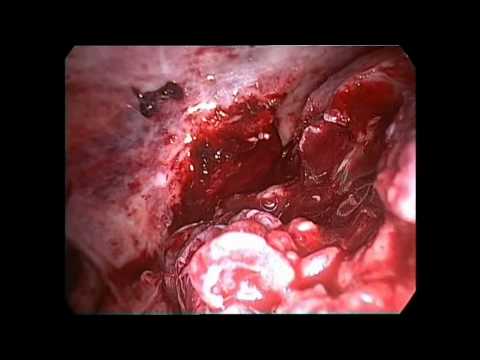 Laparoscopic Appendicular Mass Dissection  Difficult Appendectomy
